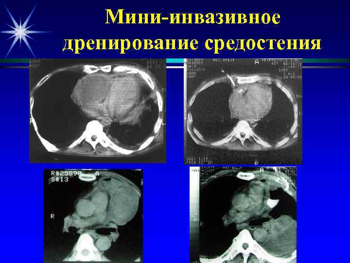 Мини-инвазивное дренирование средостения 