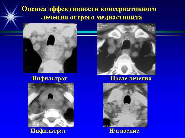 Оценка эффективности консервативного лечения острого медиастинита Инфильтрат После лечения Инфильтрат Нагноение 