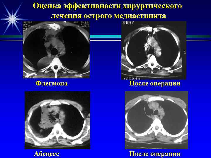 Оценка эффективности хирургического лечения острого медиастинита Флегмона После операции Абсцесс После операции 