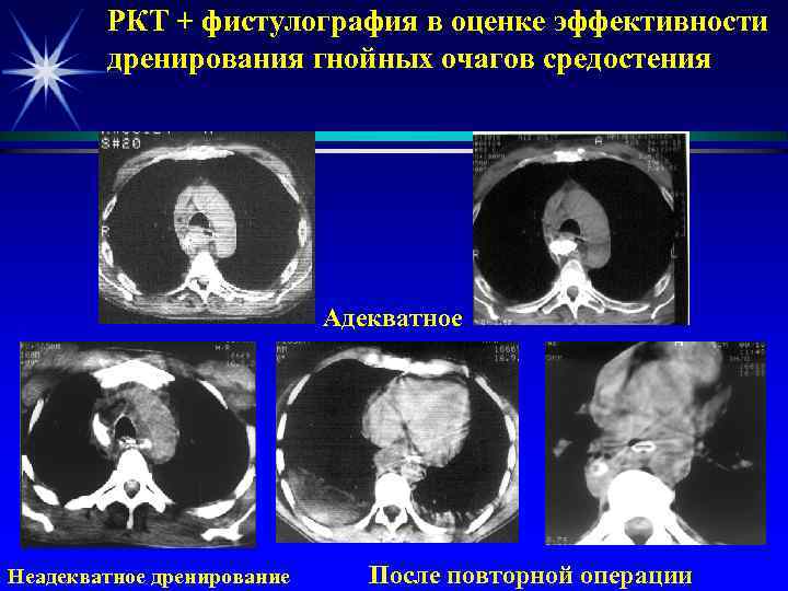 РКТ + фистулография в оценке эффективности дренирования гнойных очагов средостения Адекватное Неадекватное дренирование После