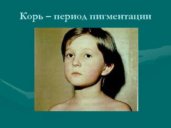 Корь – период пигментации 