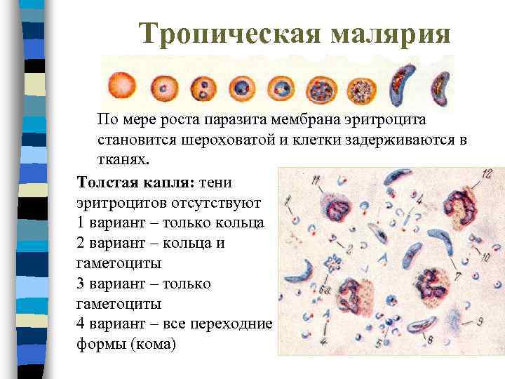 Тропическая малярия По мере роста паразита мембрана эритроцита становится шероховатой и клетки задерживаются в