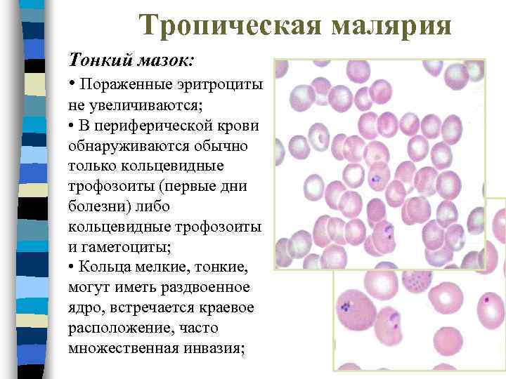 Тропическая малярия Тонкий мазок: • Пораженные эритроциты не увеличиваются; • В периферической крови обнаруживаются