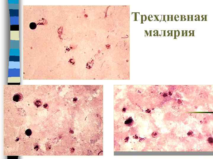 Трехдневная малярия 