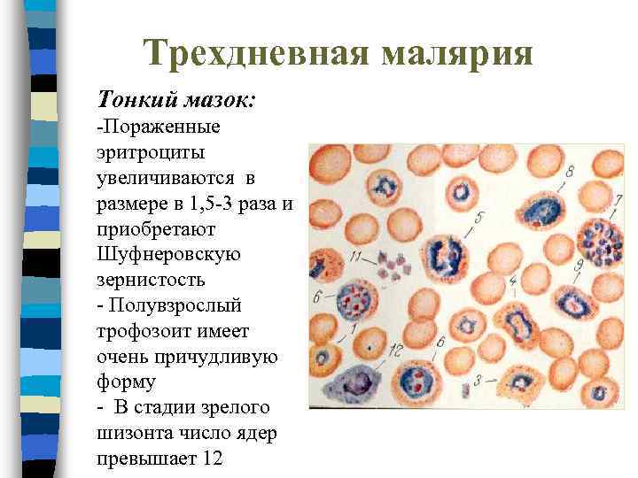 Трехдневная малярия Тонкий мазок: -Пораженные эритроциты увеличиваются в размере в 1, 5 -3 раза