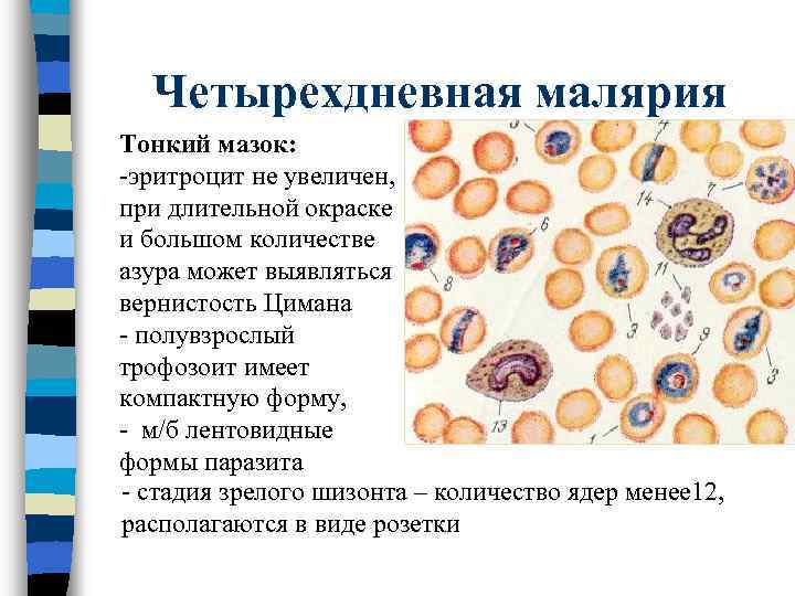 Четырехдневная малярия Тонкий мазок: -эритроцит не увеличен, при длительной окраске и большом количестве азура