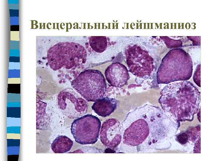 Висцеральный лейшманиоз 