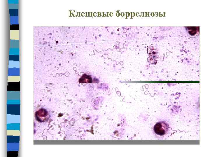 Клещевые боррелиозы 