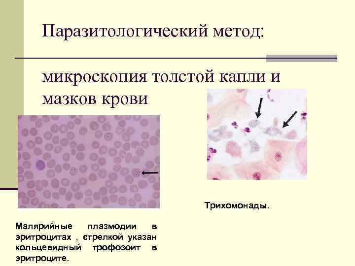 Паразитологический метод: микроскопия толстой капли и мазков крови Трихомонады. Малярийные плазмодии в эритроцитах ,