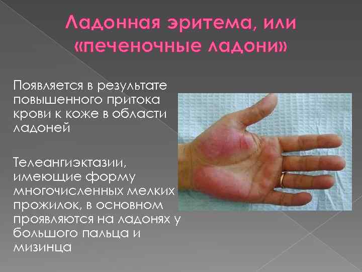 Ладонная эритема, или «печеночные ладони» Появляется в результате повышенного притока крови к коже в