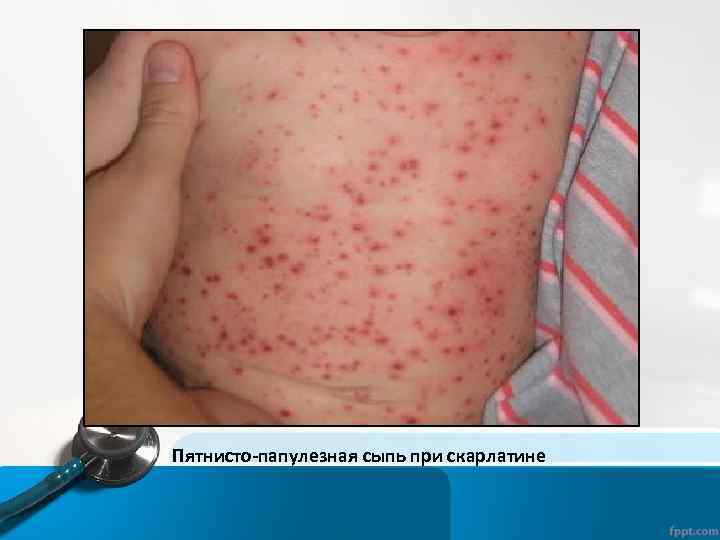 Пятнисто-папулезная сыпь при скарлатине 