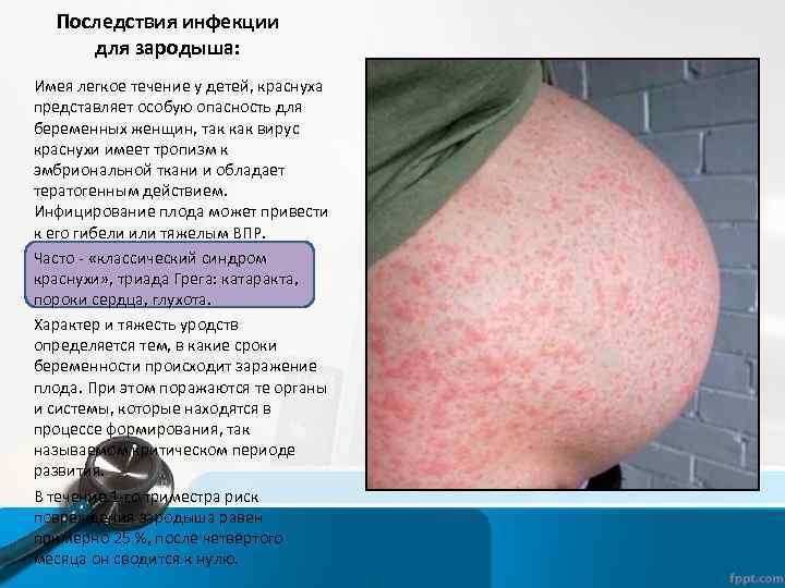 Последствия инфекции для зародыша: Имея легкое течение у детей, краснуха представляет особую опасность для