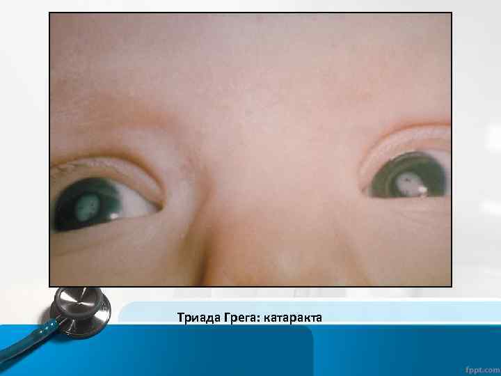 Триада Грега: катаракта 