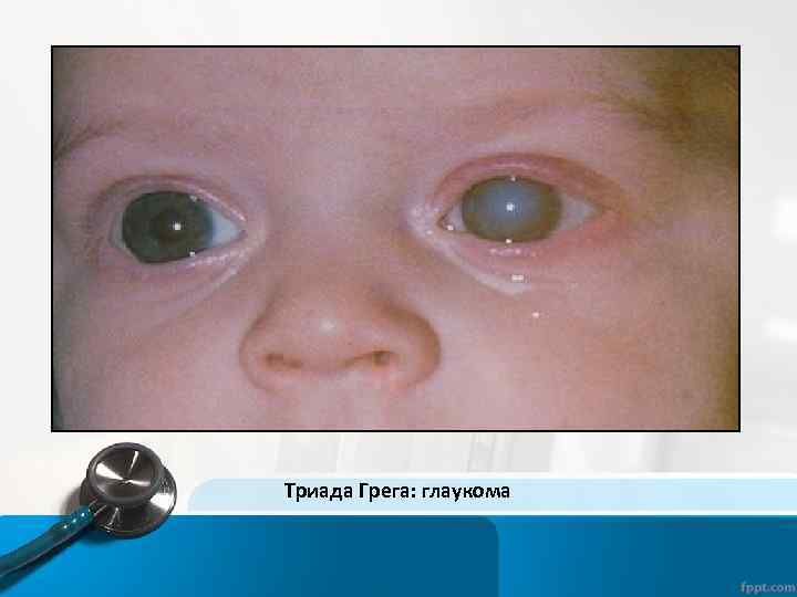 Триада Грега: глаукома 
