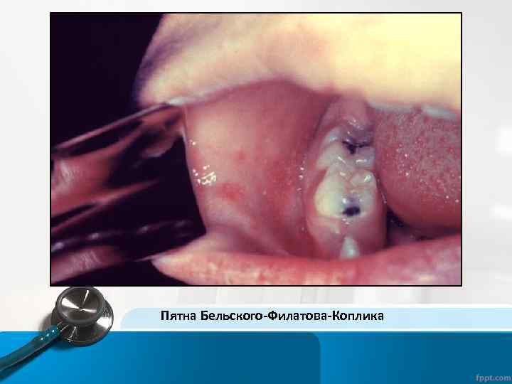 Пятна Бельского-Филатова-Коплика 