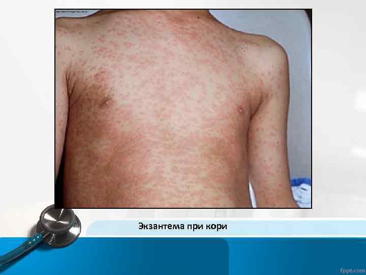 Экзантема при кори 