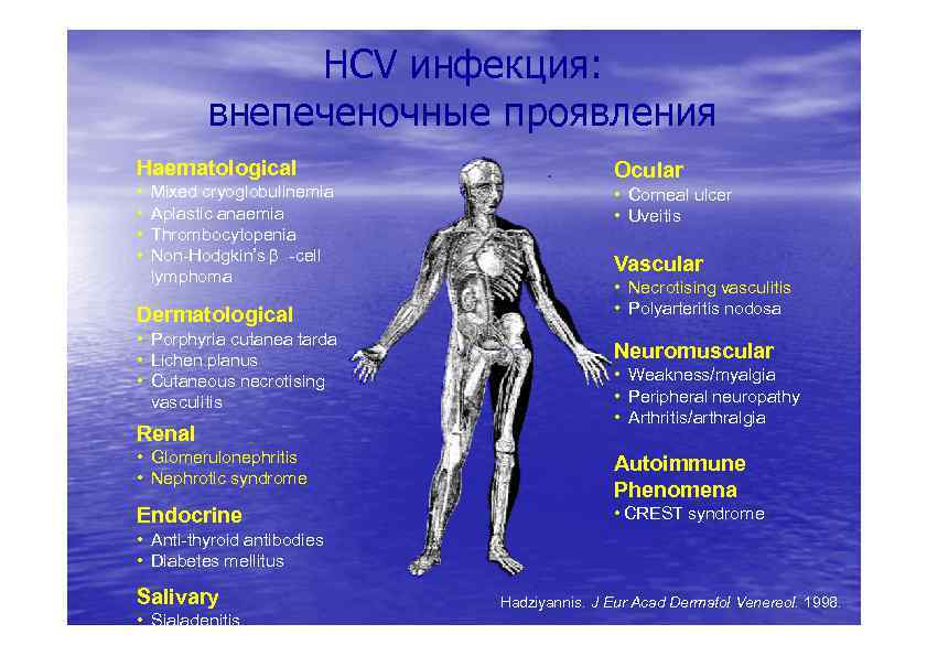 HCV инфекция: внепеченочные проявления п Haematological • • Mixed cryoglobulinemia Aplastic anaemia Thrombocytopenia Non-Hodgkin’s