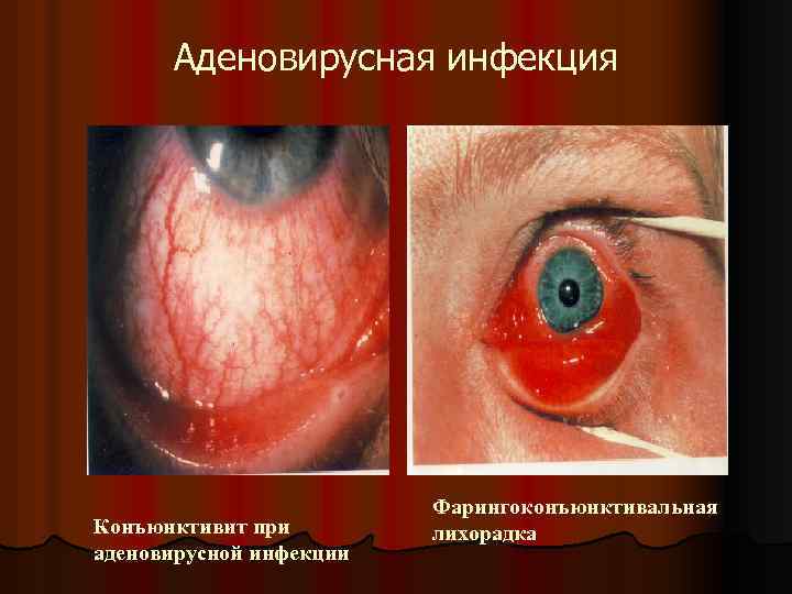 Аденовирусная инфекция Конъюнктивит при аденовирусной инфекции Фарингоконъюнктивальная лихорадка 