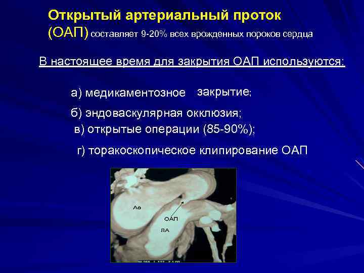 Открытый артериальный проток (ОАП) составляет 9 -20% всех врожденных пороков сердца В настоящее время