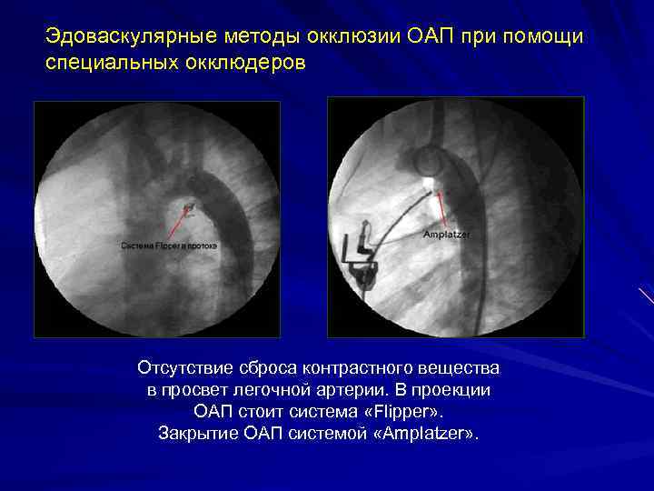 Эдоваскулярные методы окклюзии ОАП при помощи специальных окклюдеров Отсутствие сброса контрастного вещества в просвет