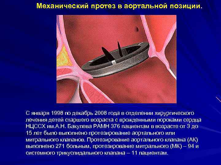 Механический протез в аортальной позиции. С января 1998 по декабрь 2008 года в отделении