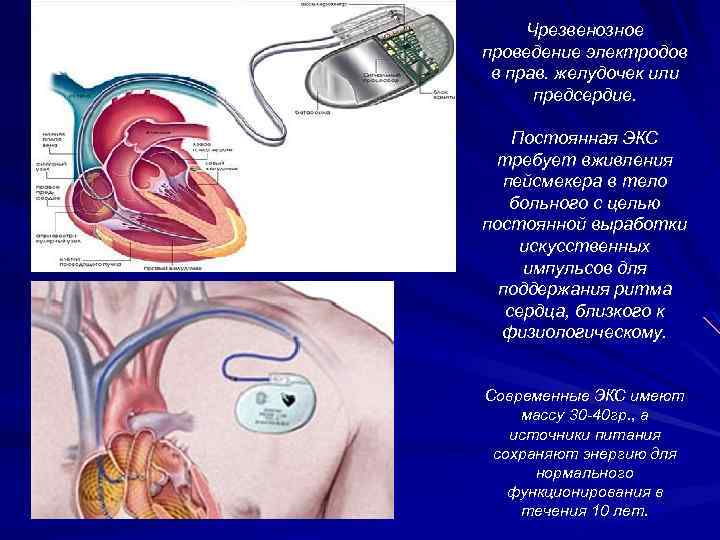 Чрезвенозное проведение электродов в прав. желудочек или предсердие. Постоянная ЭКС требует вживления пейсмекера в