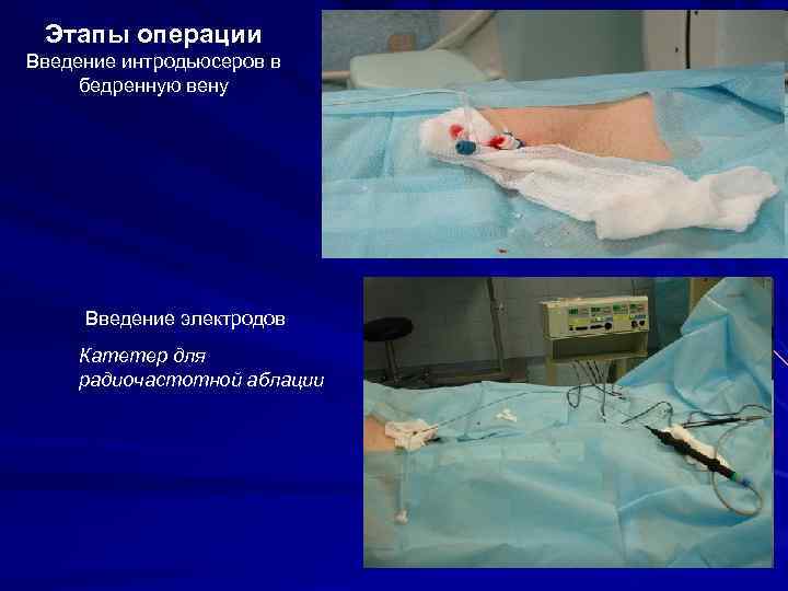 Этапы операции Введение интродьюсеров в бедренную вену Введение электродов Катетер для радиочастотной аблации 