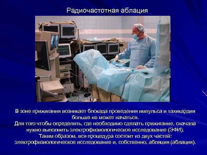 Радиочастотная аблация В зоне прижигания возникает блокада проведения импульса и тахикардия больше не может