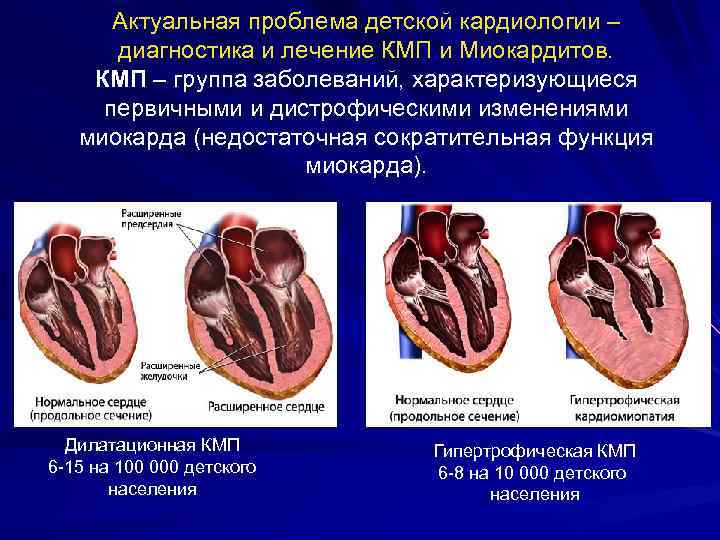 Актуальная проблема детской кардиологии – диагностика и лечение КМП и Миокардитов. КМП – группа