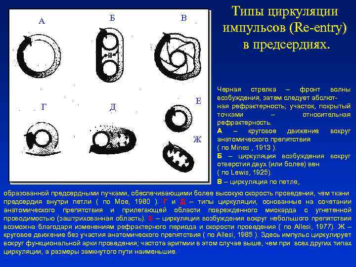 А Г Б Д Типы циркуляции импульсов (Re-entry) в предсердиях. В Е Ж Черная