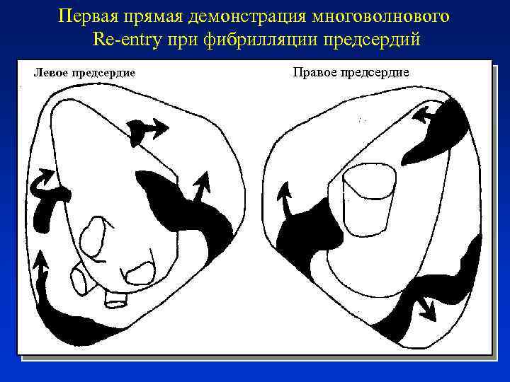 Первая прямая демонстрация многоволнового Re-entry при фибрилляции предсердий Левое предсердие Правое предсердие 