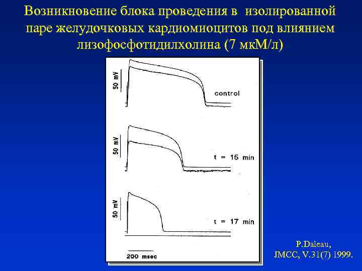 Возникновение блока проведения в изолированной паре желудочковых кардиомиоцитов под влиянием лизофосфотидилхолина (7 мк. М/л)