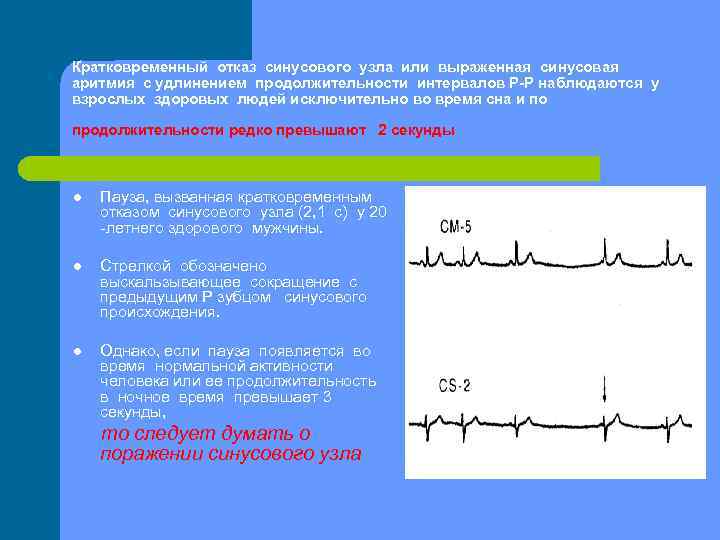 Кратковременный отказ синусового узла или выраженная синусовая аритмия с удлинением продолжительности интервалов Р-Р наблюдаются