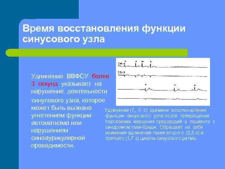 Время восстановления функции синусового узла Удлинение ВВФСУ более 3 секунд указывает на нарушение деятельности
