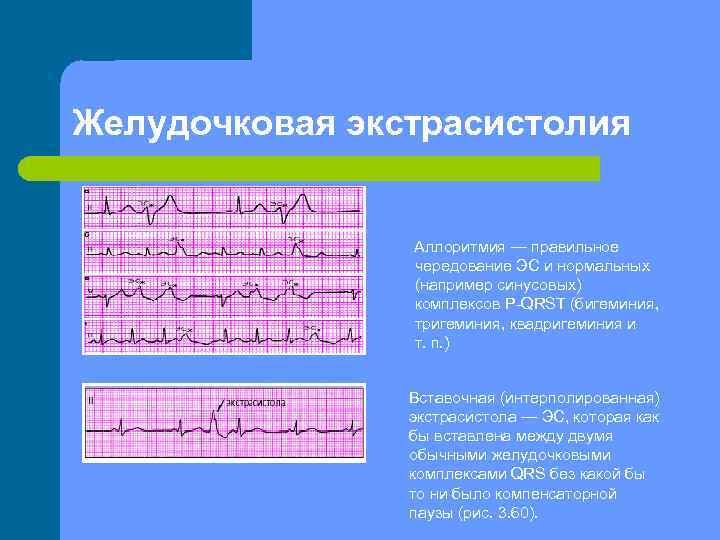 Желудочковая экстрасистолия Аллоритмия — правильное чередование ЭС и нормальных (например синусовых) комплексов P QRST