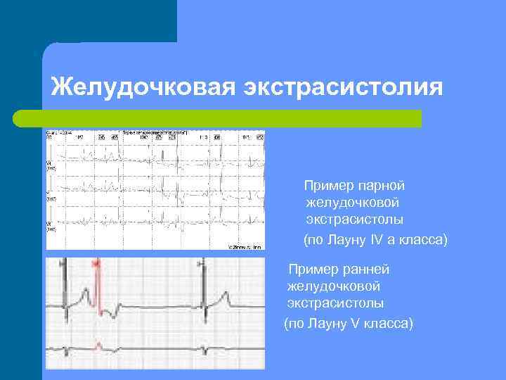 Желудочковая экстрасистолия Пример парной желудочковой экстрасистолы (по Лауну IV а класса) Пример ранней желудочковой