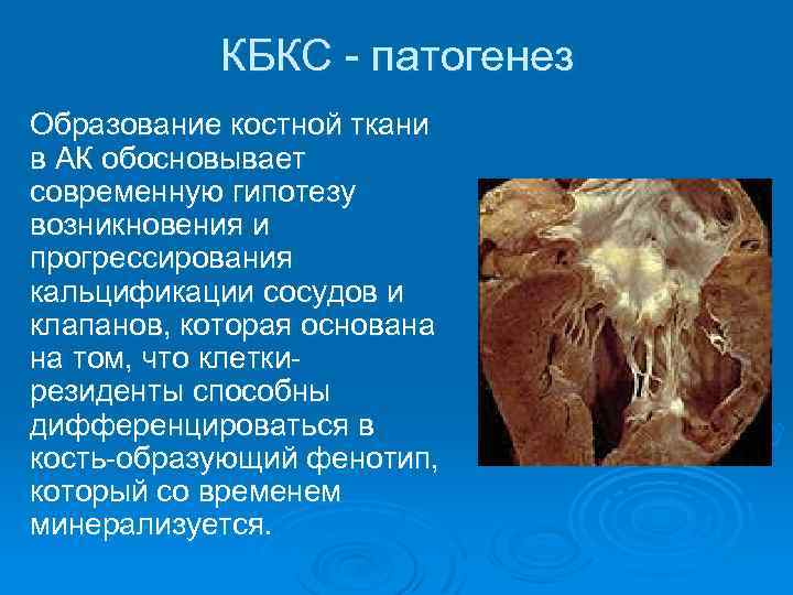 КБКС - патогенез Образование костной ткани в АК обосновывает современную гипотезу возникновения и прогрессирования