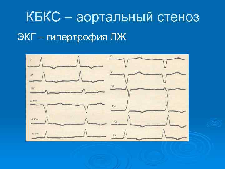 КБКС – аортальный стеноз ЭКГ – гипертрофия ЛЖ 