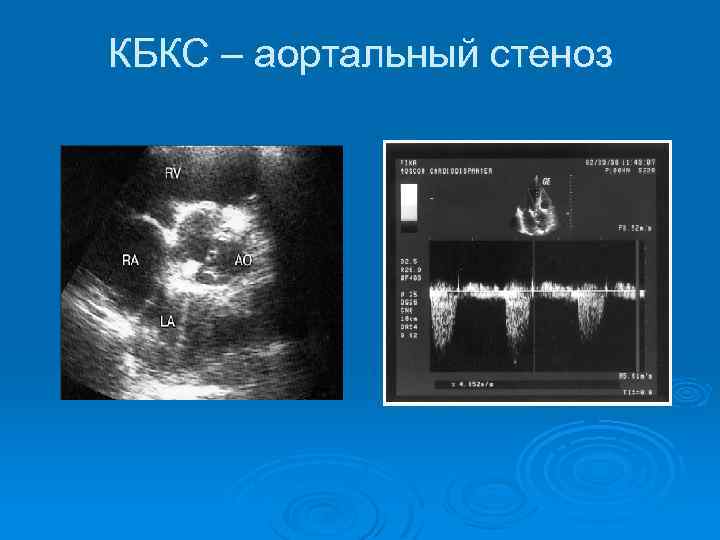 КБКС – аортальный стеноз 