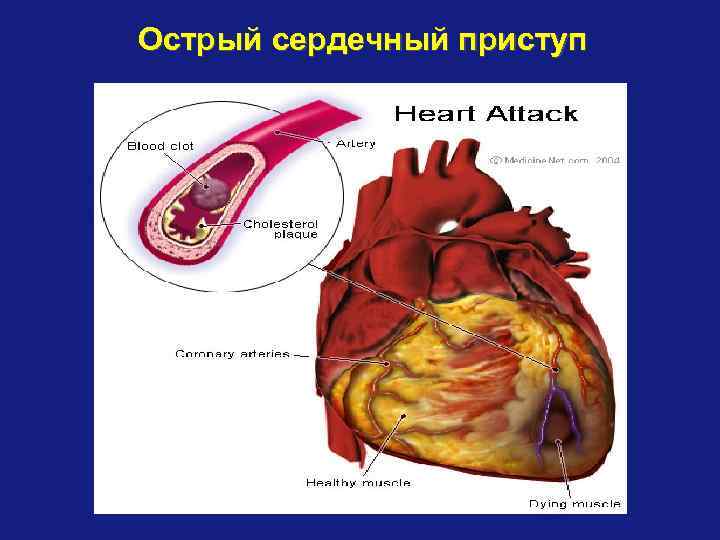 Острый сердечный приступ 