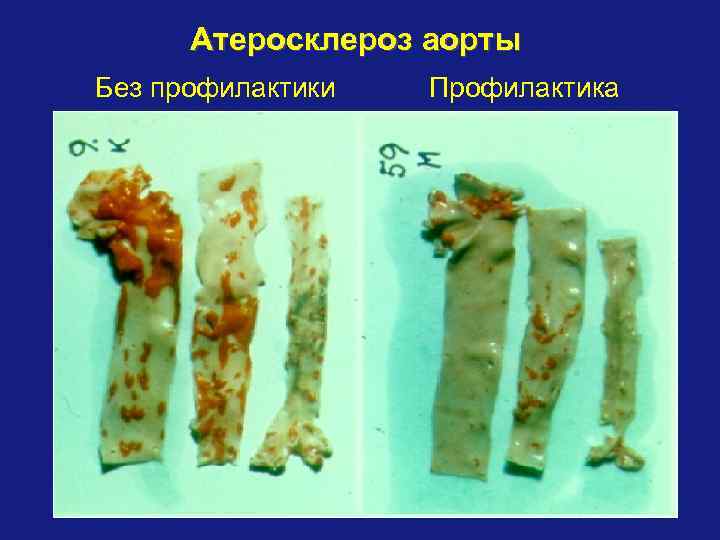 Атеросклероз аорты Без профилактики Профилактика 
