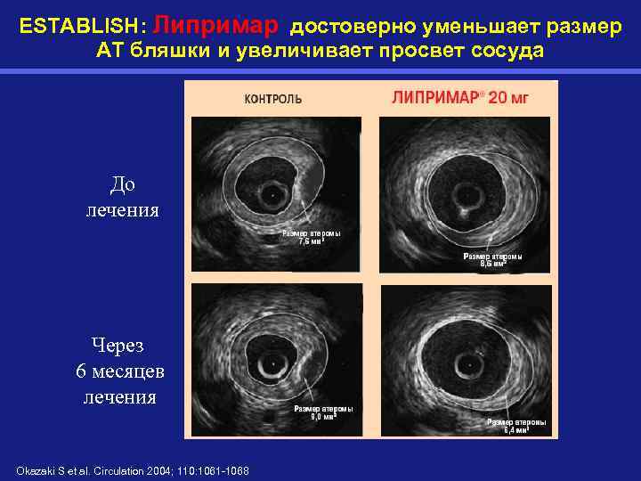 ESTABLISH: Липримар достоверно уменьшает размер АТ бляшки и увеличивает просвет сосуда До лечения Через