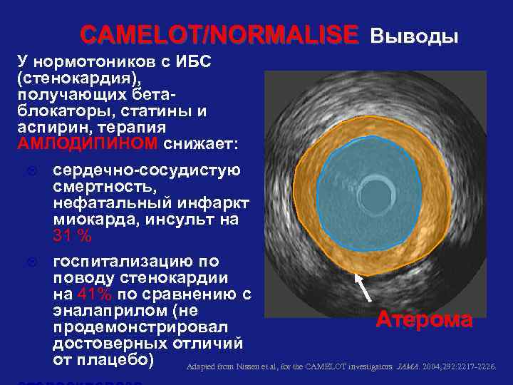 CAMELOT/NORMALISE Выводы У нормотоников с ИБС (стенокардия), получающих бетаблокаторы, статины и аспирин, терапия АМЛОДИПИНОМ