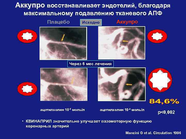 Аккупро восстанавливает эндотелий, благодаря максимальному подавлению тканевого АПФ Плацебо Аккупро Исходно Через 6 мес