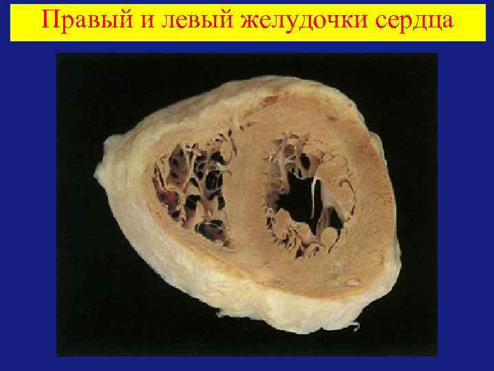 Правый и левый желудочки сердца 