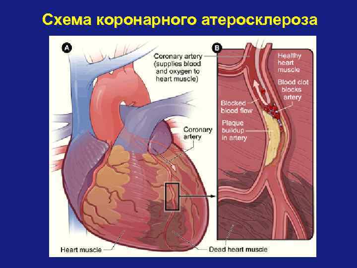 Схема коронарного атеросклероза 