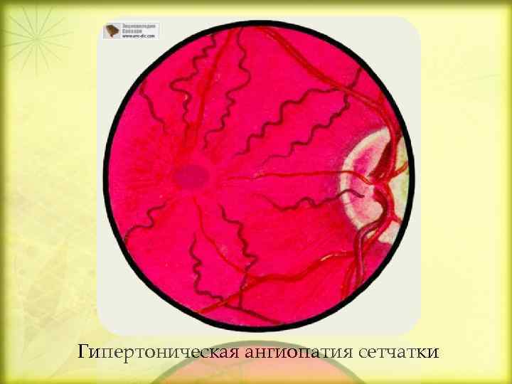 Гипертоническая ангиопатия сетчатки 
