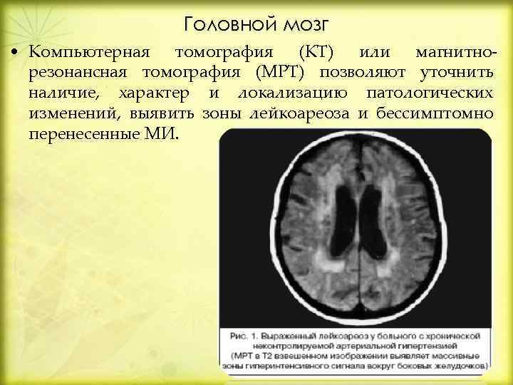 Головной мозг • Компьютерная томография (КТ) или магнитнорезонансная томография (МРТ) позволяют уточнить наличие, характер