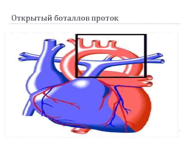 Открытый боталлов проток 