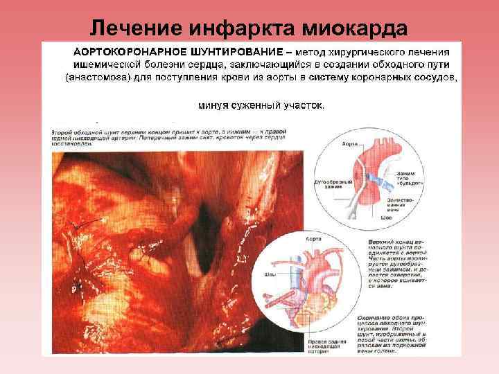 Лечение инфаркта миокарда 